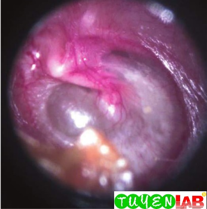 Pediatric Atlas Of Otitis Media Acute Otitis And Otitis Media
