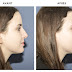 Rhinoplastie médicale : avant / après !