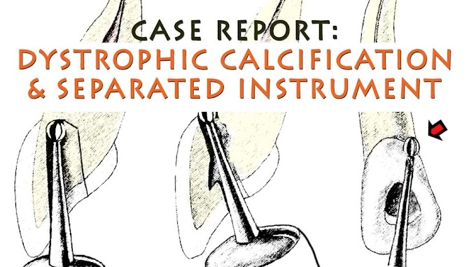 ENDODONTIC: Dystrophic Calcification and Instrument removal - Allen Ali Nasseh