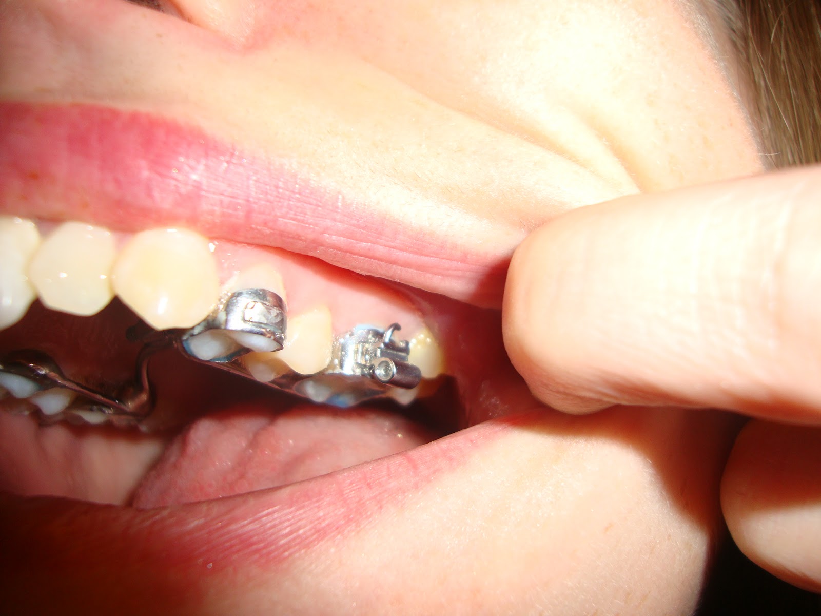 23 Year Old Brace Face September 2012