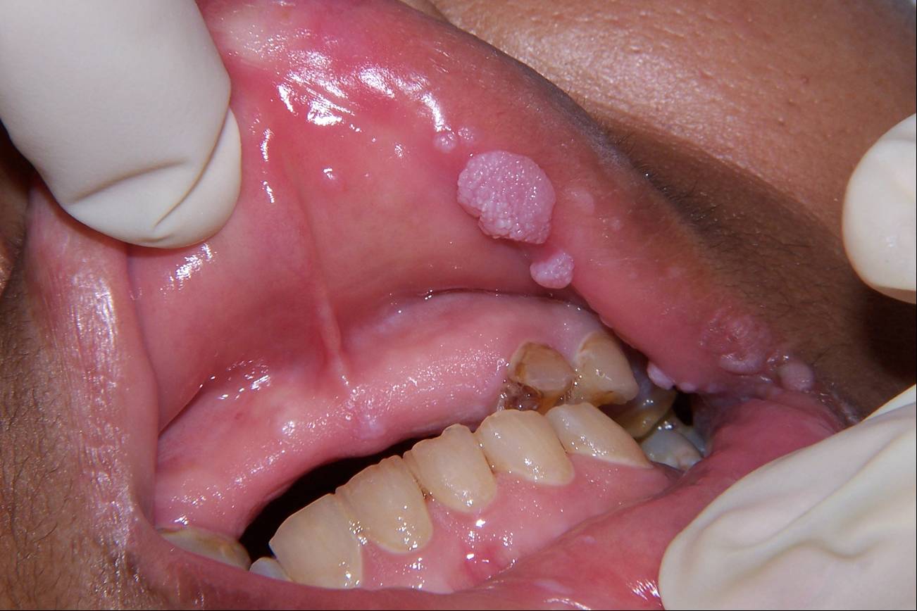 Oral E 11