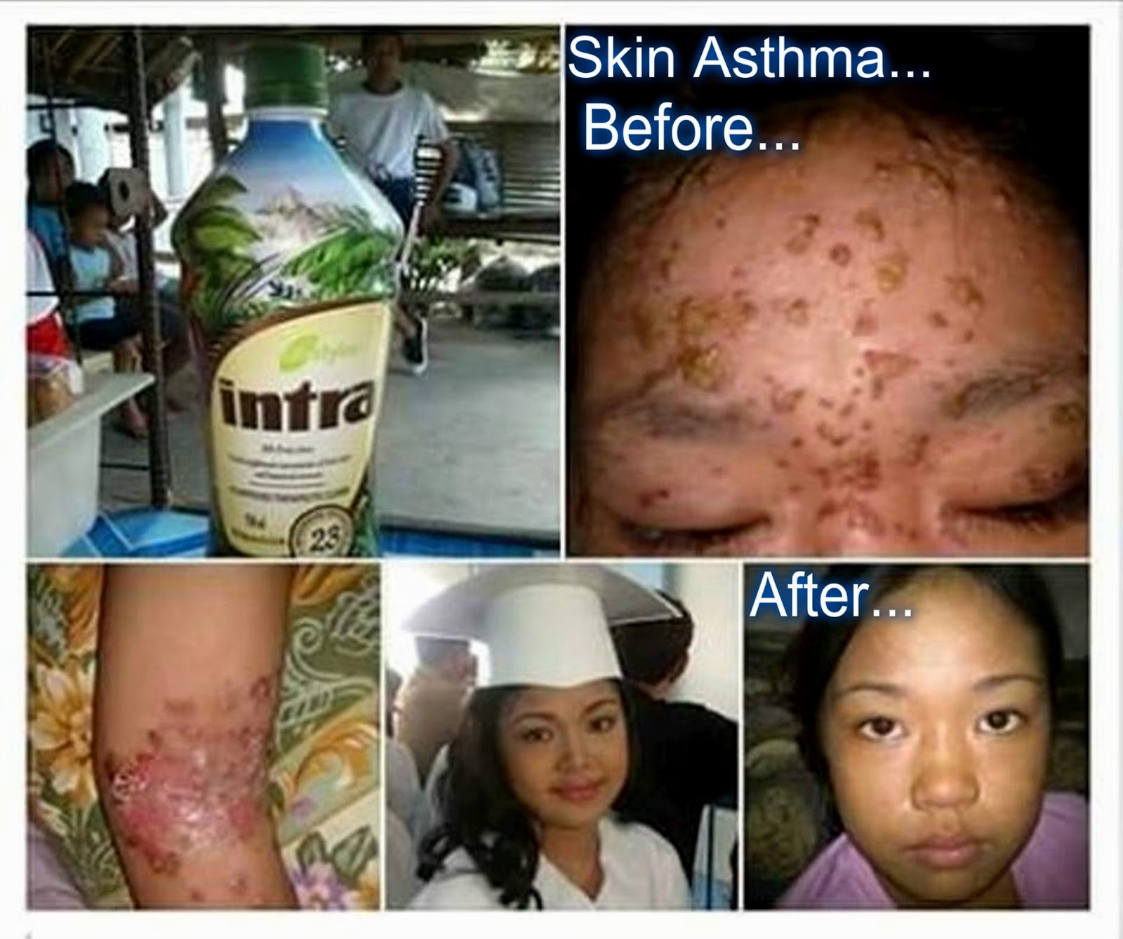 An Invite to Abundant Life PSORIASIS, ECZEMA, SKIN ASTHMA, AND OTHER