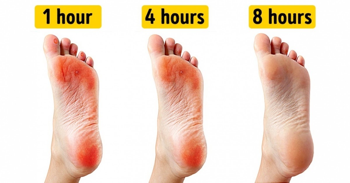 How to get rid of blisters on feet naturally beauty4everything3