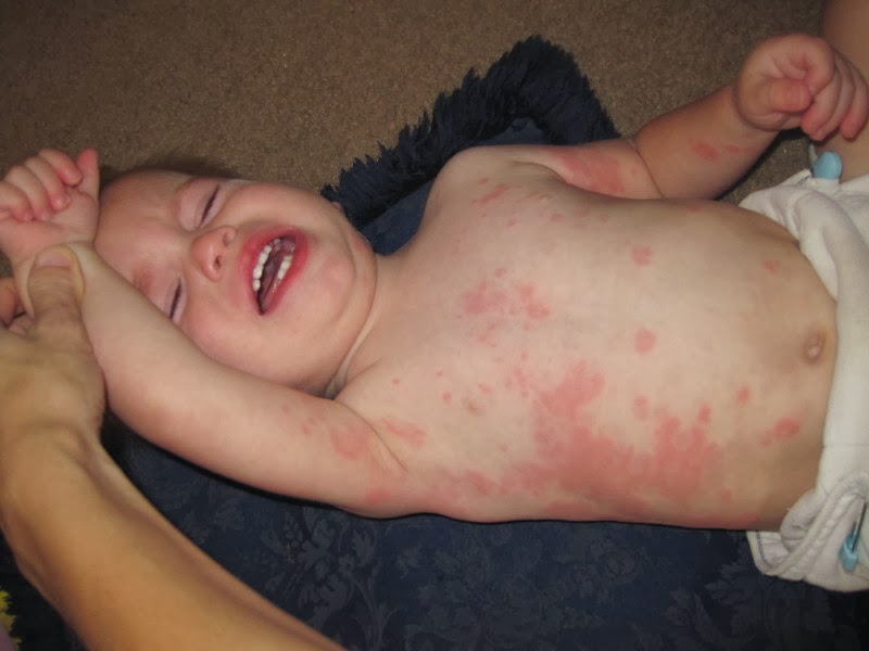 Heissatopia Hives and carrots