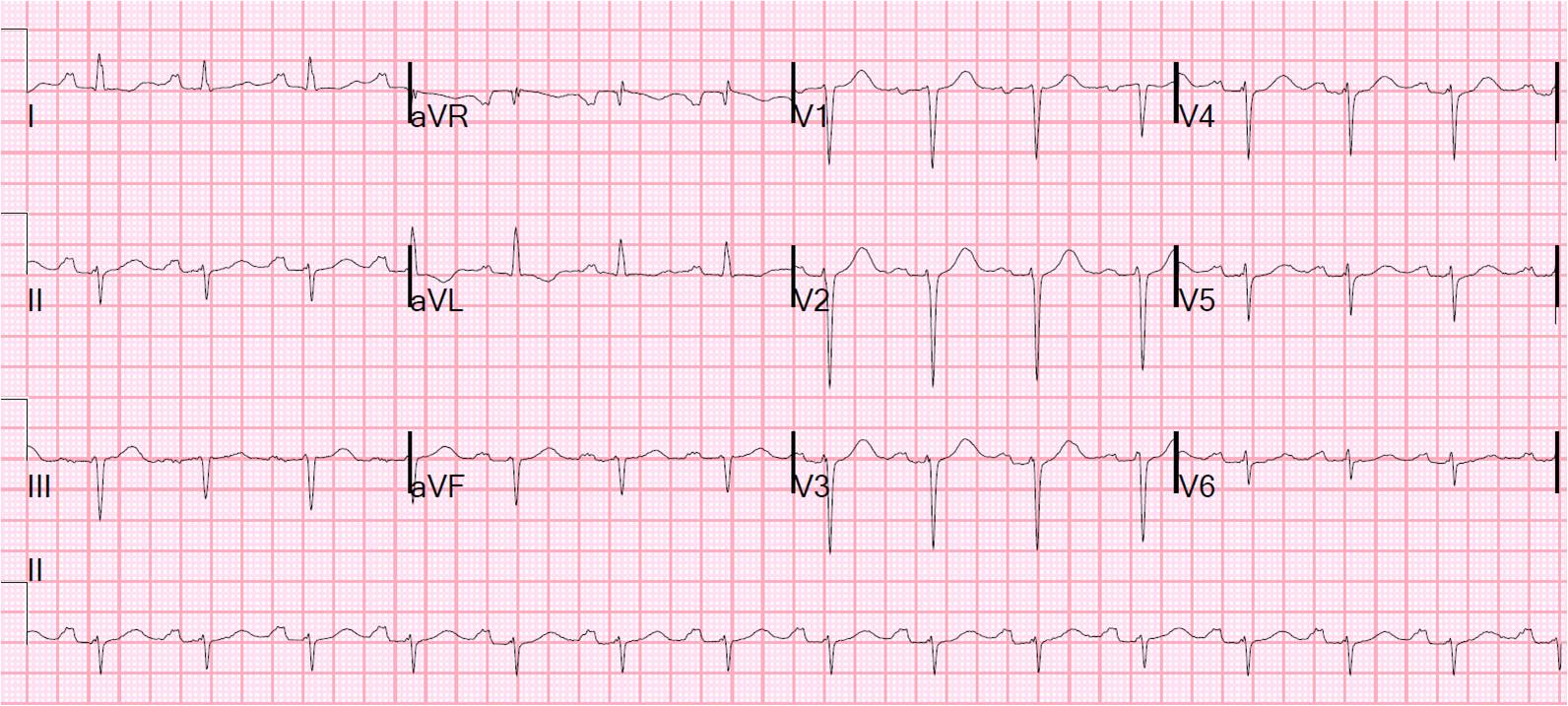 Dr. Smith's ECG Blog Tachycardia with Pericardial Effusion