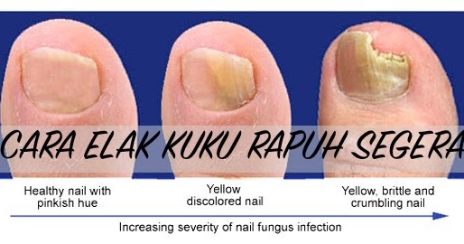 Download Cara Merawat Kuku Rosak Pictures