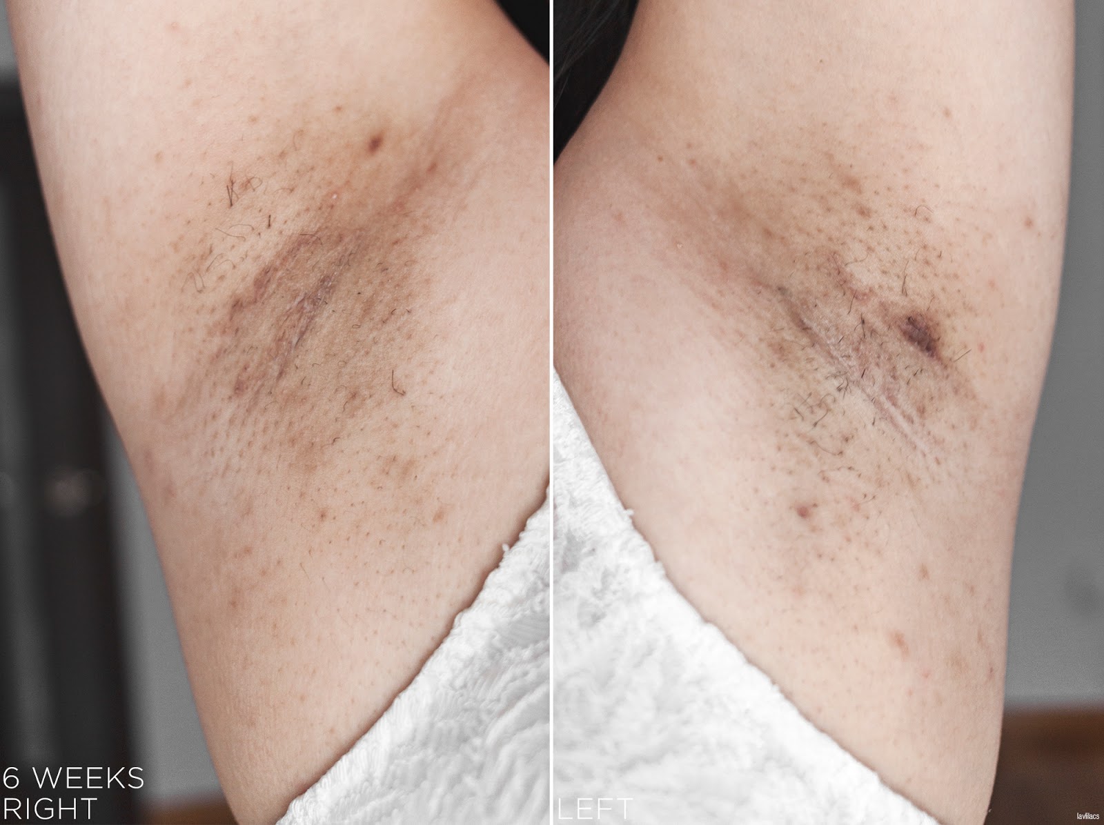 tria Hair Removal Laser Armpits Hair 6 Weeks