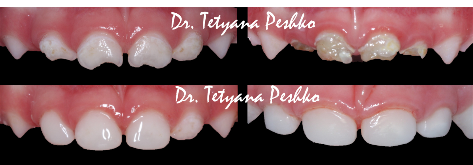 наращивают ли зубы детям. наращивают ли зубы детям. наращивают ли зубы детям. наращивают ли зубы детям. наращивание передних зубов.