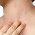 10 Natural & Homemade Solutions For Prickly Heat Rashes