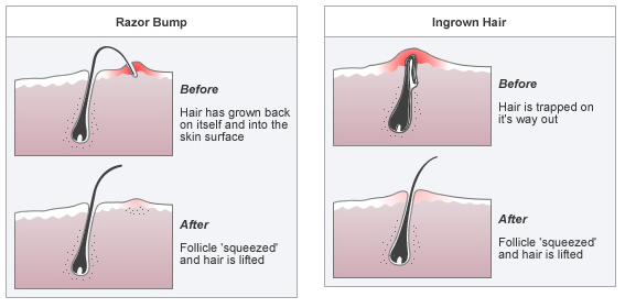 Ingrown Facial Hair Bumps 5