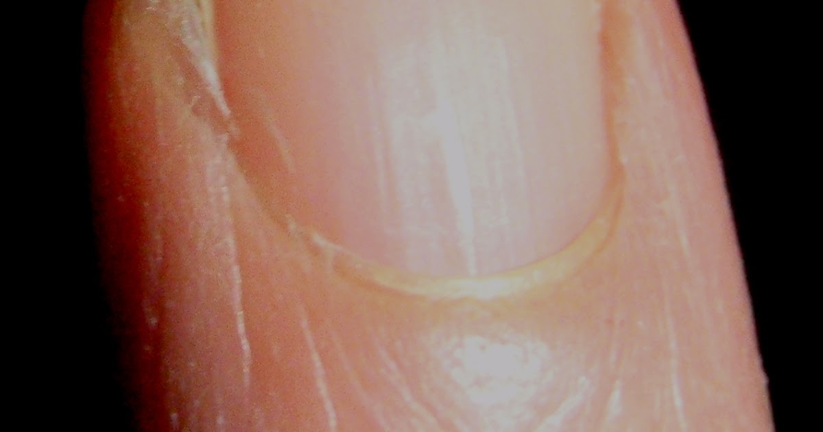 How to Handle a Hangnail