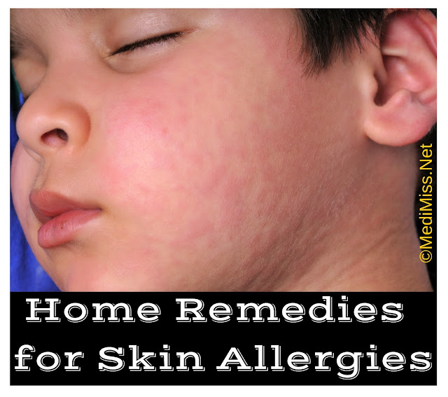 Home Remedies to Treat Food Allergies Top 10 Home Remedies | Home ...