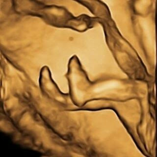 18 haftalık gebelik görüntüsü