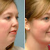 Incredible Exercises In Order To Tighten Up Your Loose Skin And Lose Double Chin
