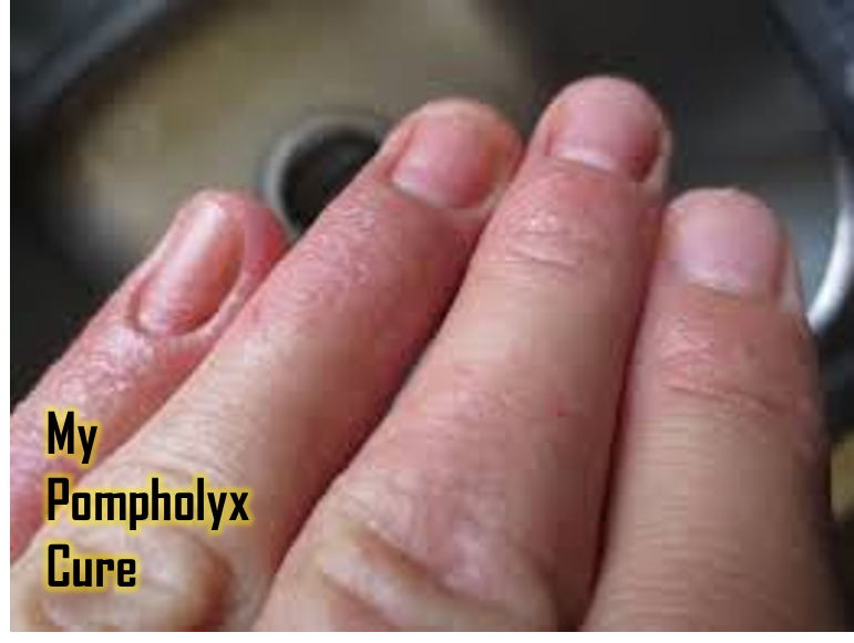 My Pompholyx Cure - Medical Talk