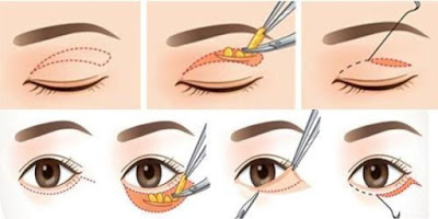 Tổng hợp các cách chữa sụp mí mắt tốt nhất 2