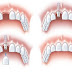 Cấy ghép răng implant có nguy hiểm không ?