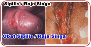 Penyakit Sipili atau Raja Singa Penyakit Sipili atau Raja Singa