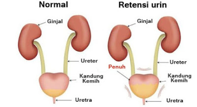 Retensi urin