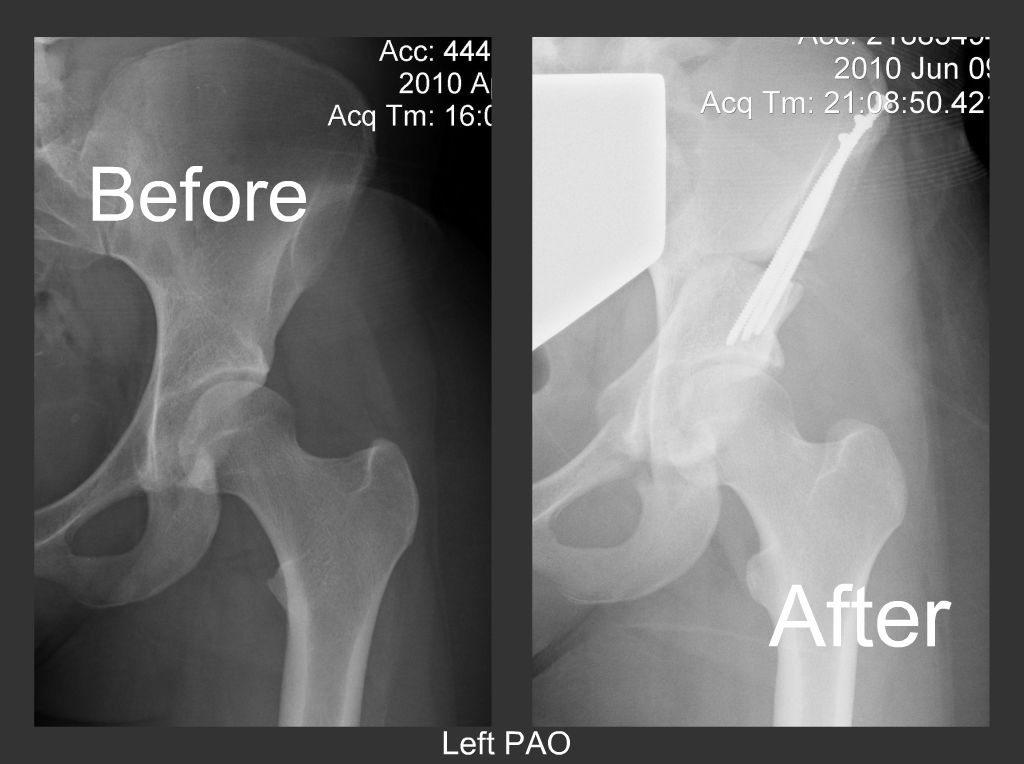 Periacetabular Osteotomy (PAO) Living with Ehlers Danlos Syndrome