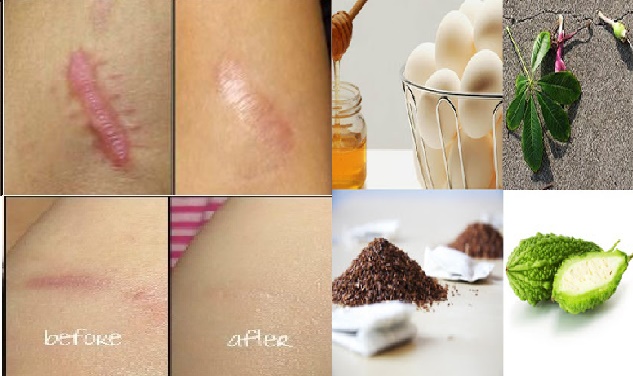 Luar Biasa!! Dalam 15 Menit Saja Bekas Luka Lama Anda Akan Hilang Dan Kulit Menjadi Halus Hanya Dengan Bahan Alami Ini..Semoga Bermanfaat..!! Jangan Lupa Bantu Sharing Ya...
