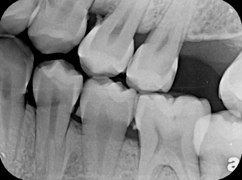 Do You Need A Dental Cleaning Before Braces