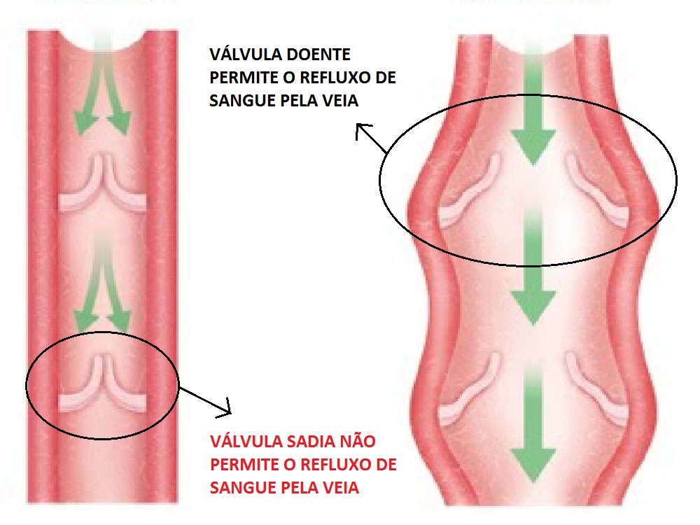 Varicele: complicatii si tratamente eficiente