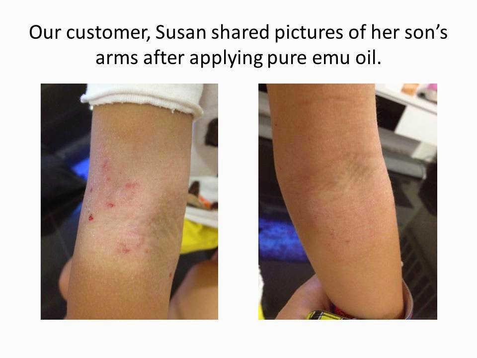 Emu Oil Benefits and Use Emu Oil Singapore