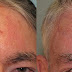Skin Cancer On Forehead Pictures & Photos