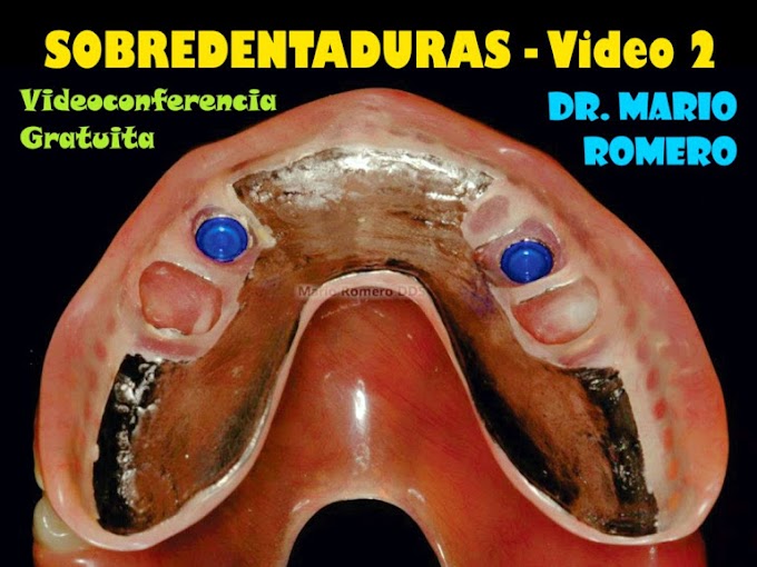 VIDEOCONFERENCIA: Sobredentaduras - Dr. Mario Romero (Video 2)