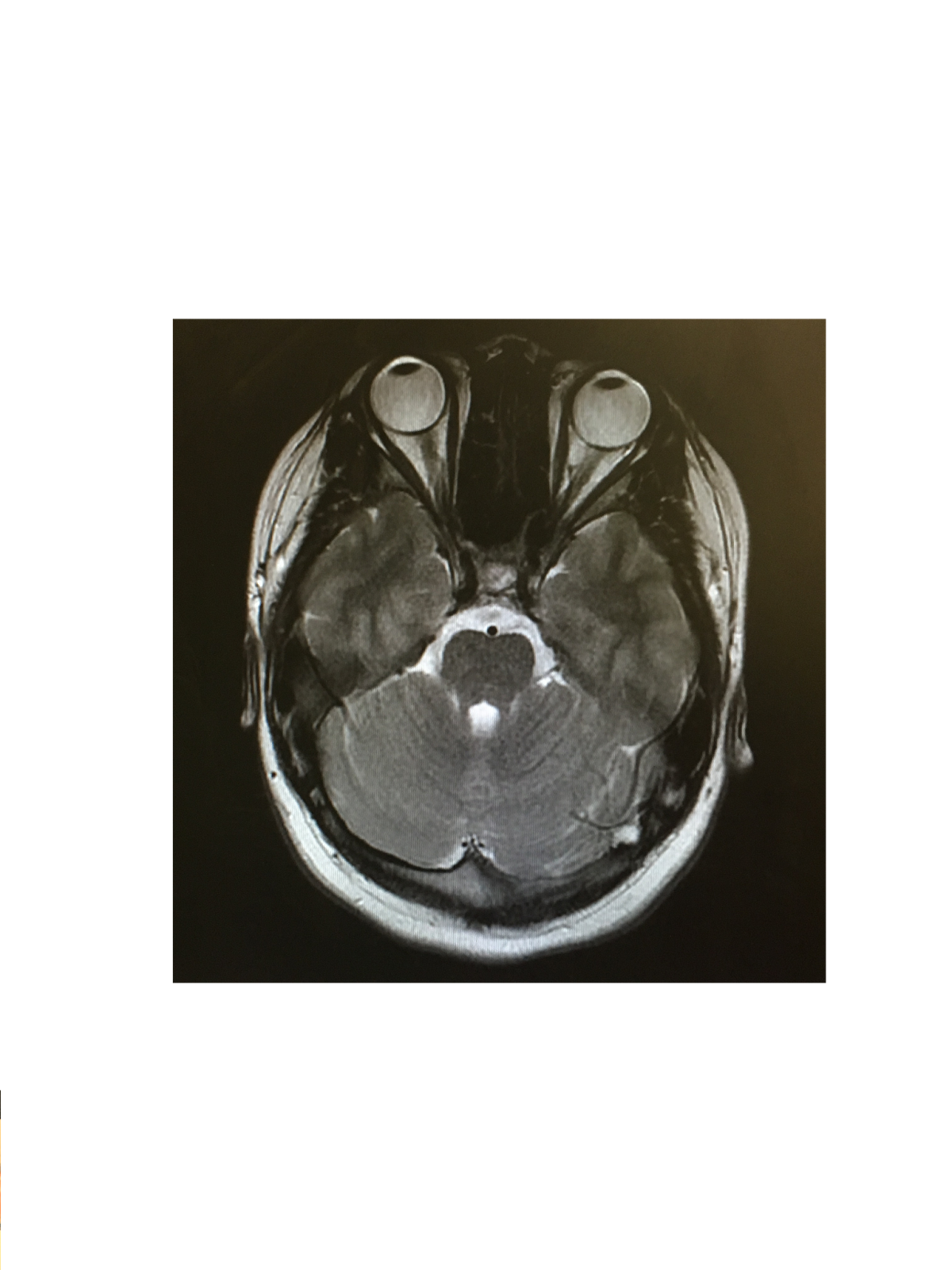 Fixing The Fat Girl's Future My Journey with Cushing's Disease MRI