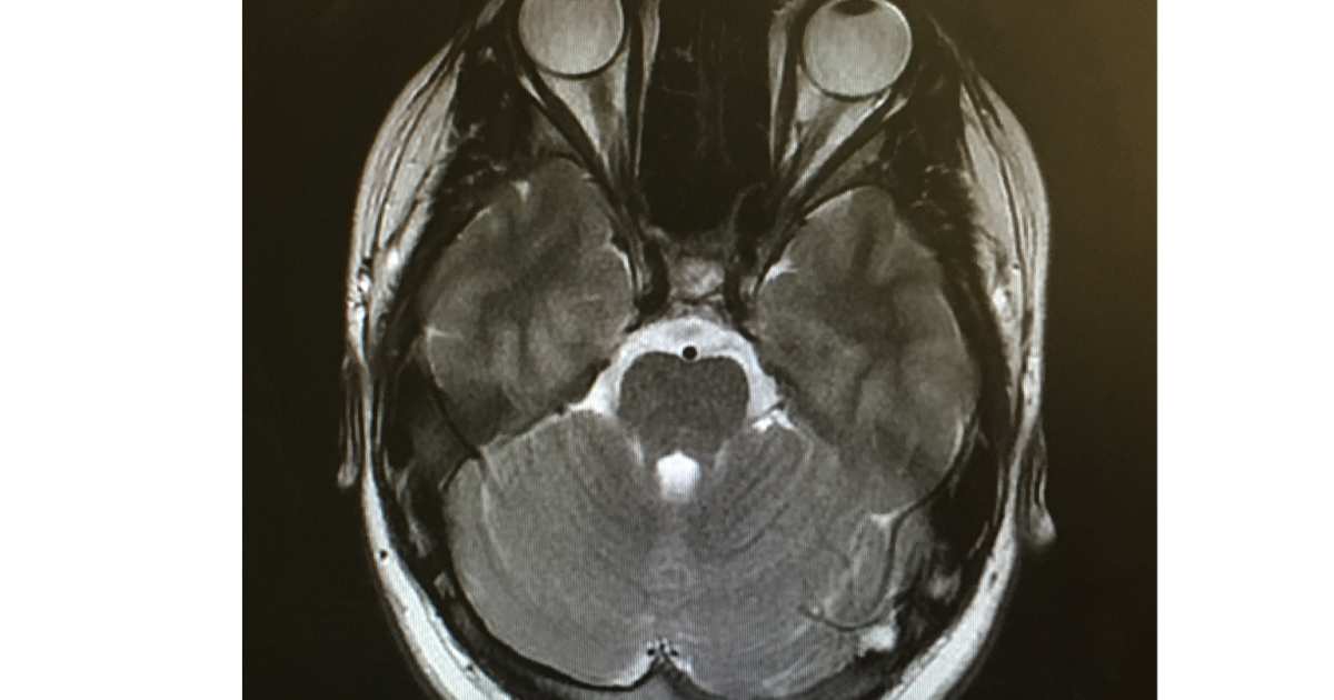 Fixing The Fat Girl's Future My Journey with Cushing's Disease MRI