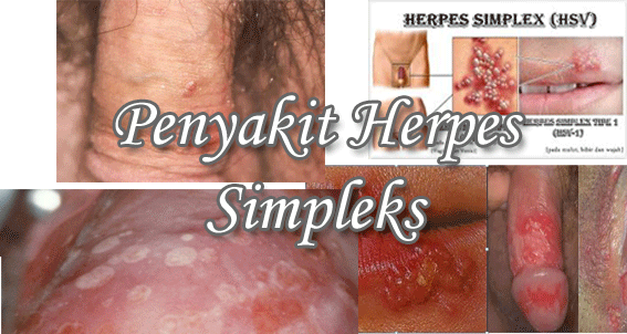Penyakit herpes simpleks