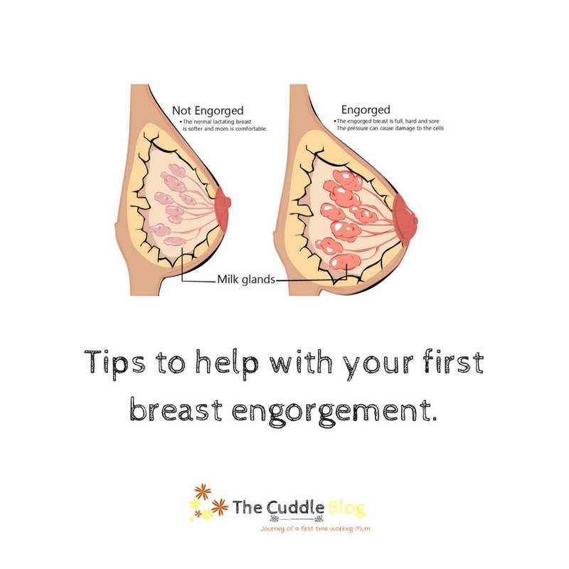 Breast Engorgement  Causes and Tips for Relief 