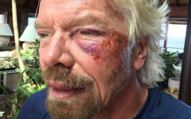 Richard Branson has revealed he was involved in a serious bike accident 