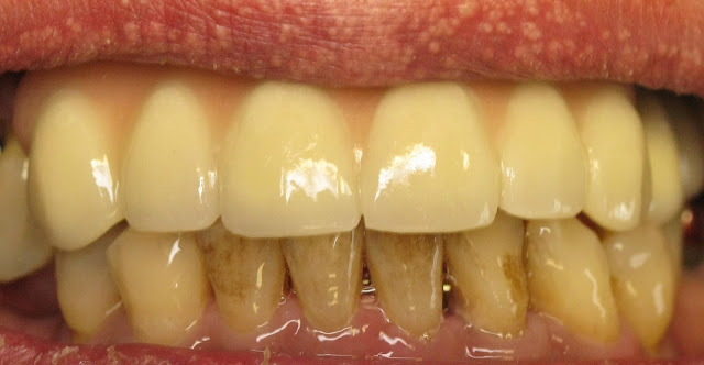 teeth stains bad very plaque whiten effective smoking fix smoke brown cavities cos causes having techniques why them too sit