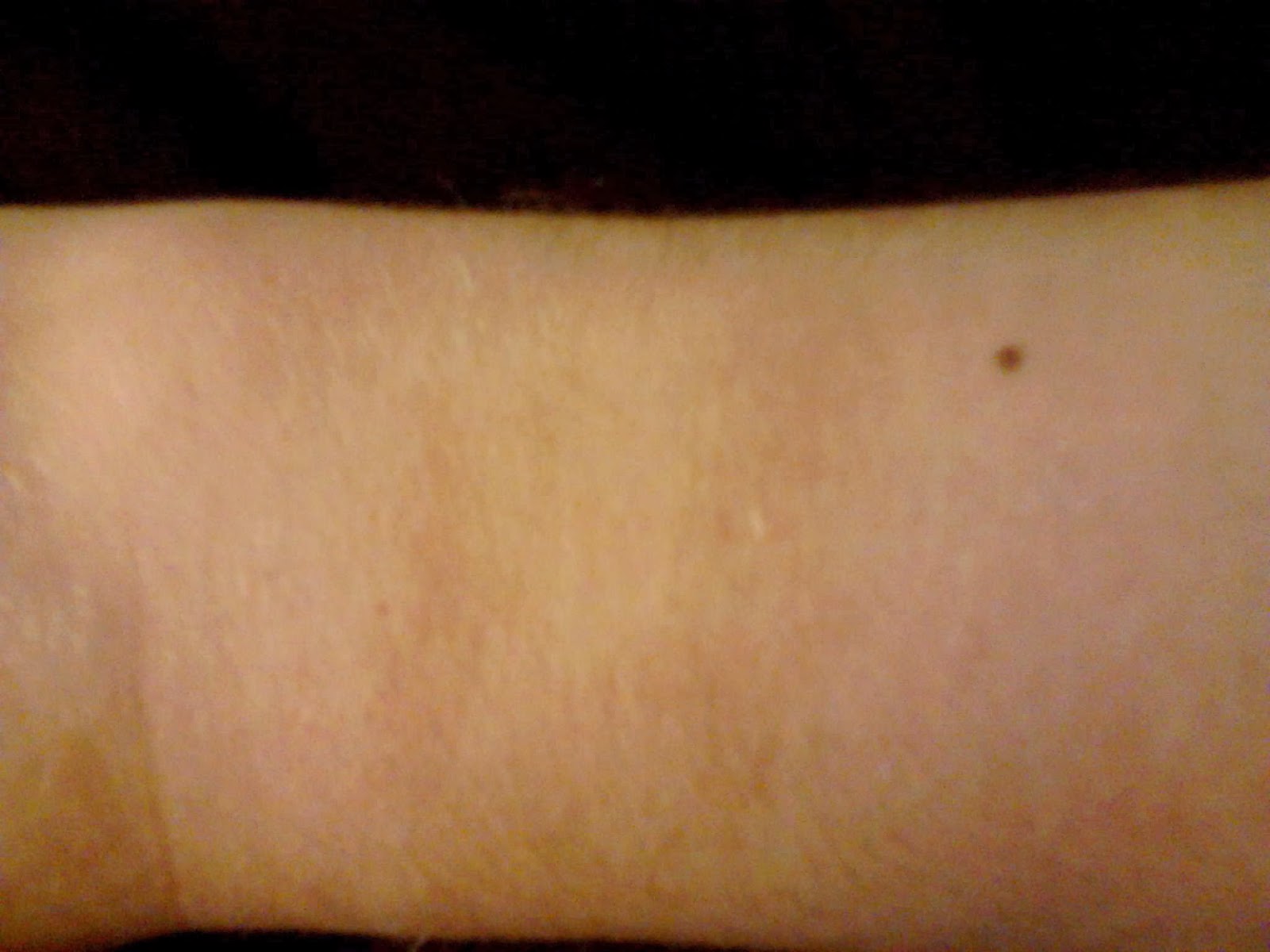 Comfortable furniture Bruising on biceps Comfortable furniture Bruising on biceps