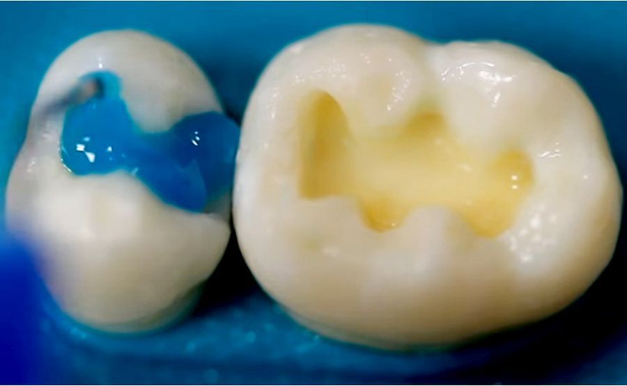 DENTAL MATERIALS Select HV Etch Technique Bisco