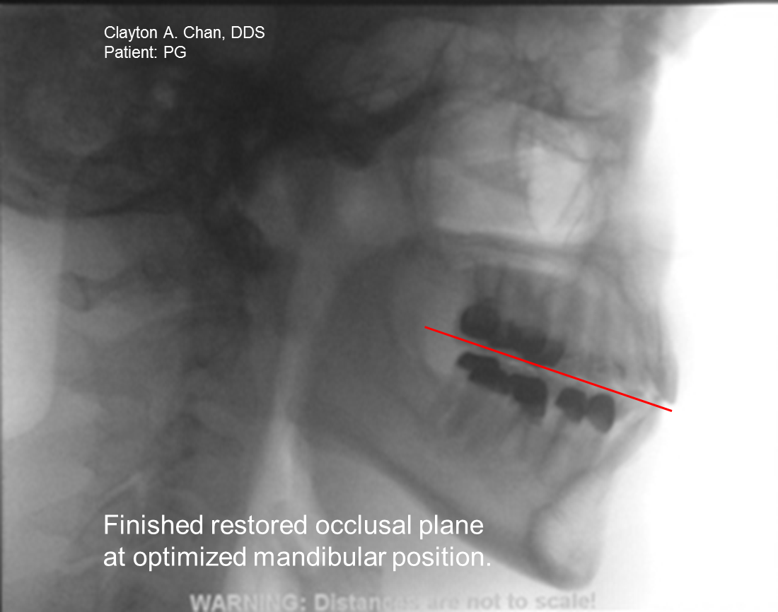 Occlusion Connections Blog What Angle is the Occlusal Plane Relative
