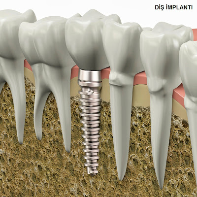 diş implantı sorunları, vidalı diş