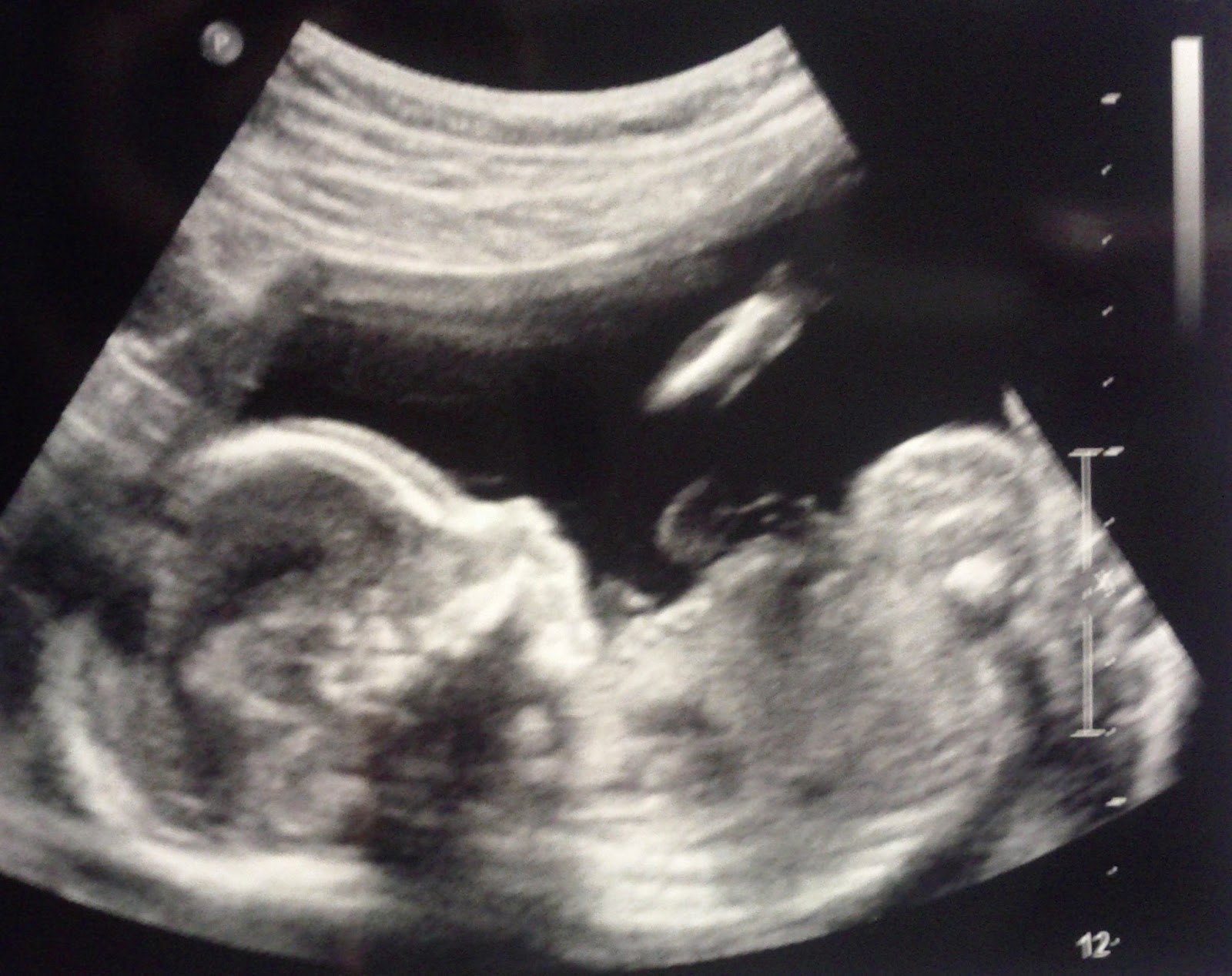 19 неделя 2023. Pregnant Ultrasound 20.