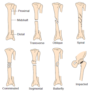 yuan's !nk: fractures and dislocations