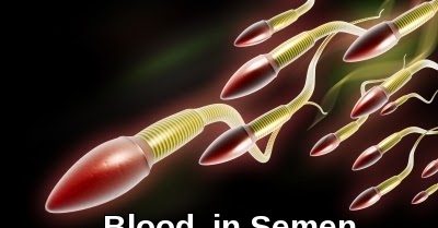 Herbalist: Penyebab Cairan Sperma Bercampur Darah Dan Obat Antibiotik