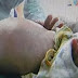 CHINA: Menino de 2 anos tinha feto não desenvolvido no estômago