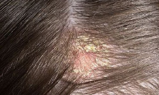 daun mangkokan untuk rambut rontok manfaat daun mangkokan untuk rambut keriting, masker mangkokan dan telur untuk rambut, mangkokan untuk rambut bayi, manfaat mangkokan untuk rambut keriting, khasiat mangkokan untuk rambut lengkap, mangkokan membuat rambut keriting, mangkokan untuk rambut botak, shampo daun mangkokan