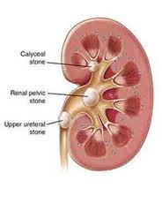 calculos-renales
