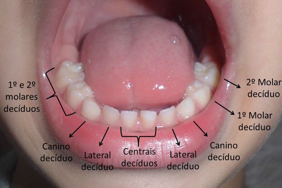 Blog da Dentista Vanice Nomenclatura da Dentição Decídua ou Dentição