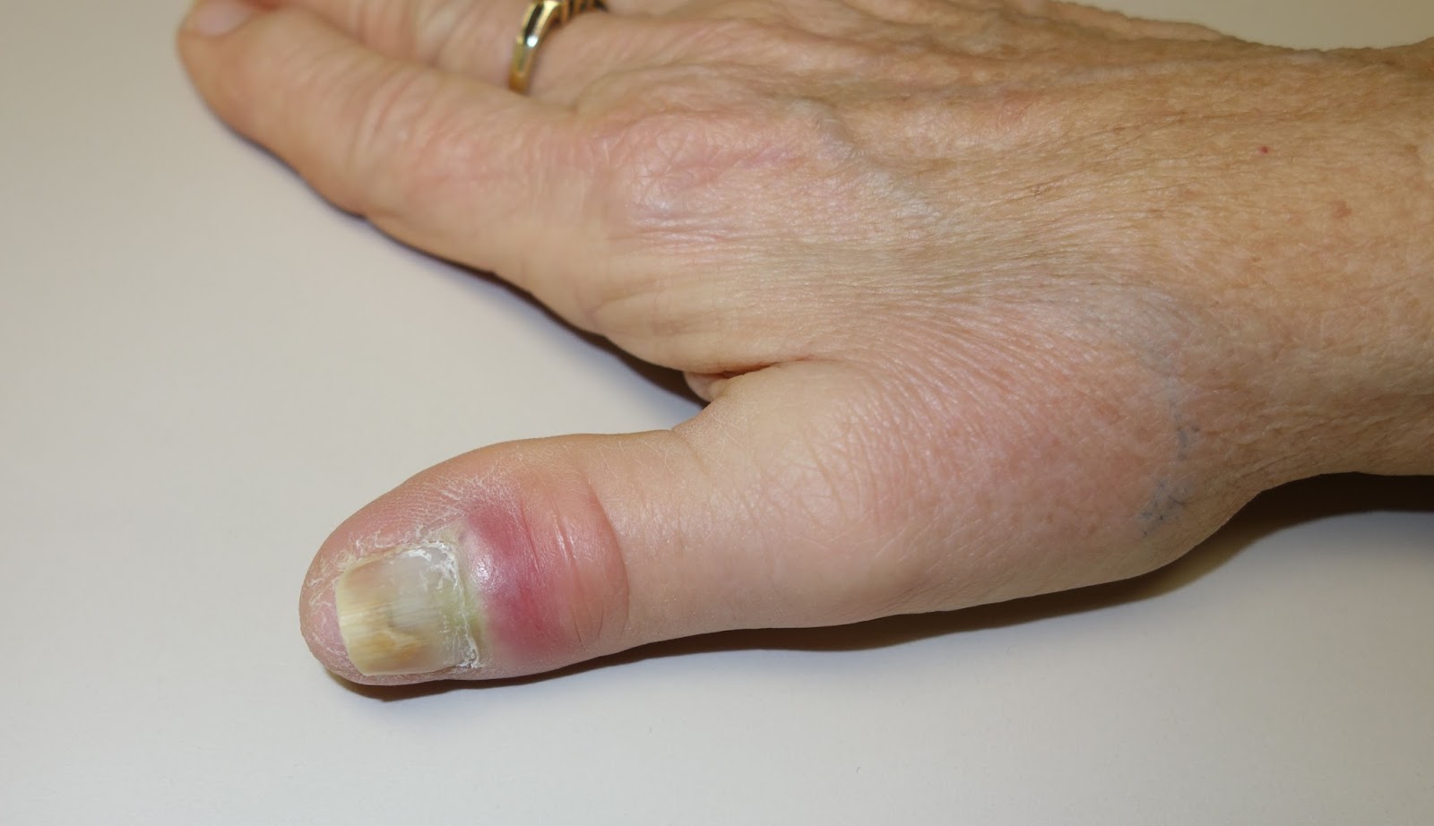 Ingrown toenails - treatment, symptoms, causes and prevention | healthdirect