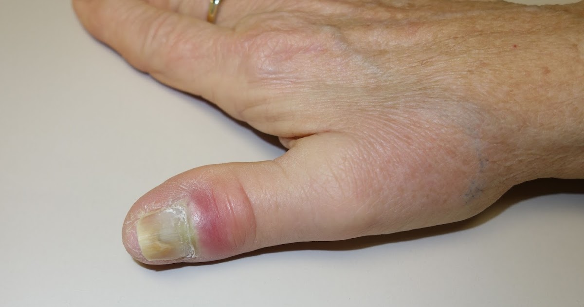 fingernail-bump-congenital-hand-and-arm-differences
