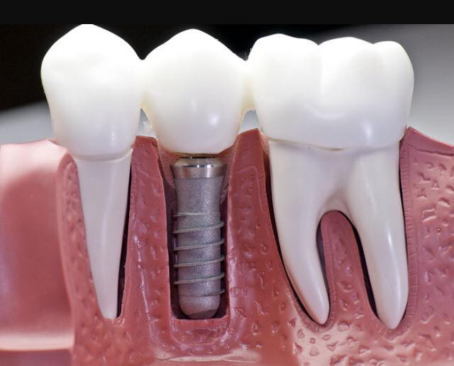 Dental Blog Mini Residency In Implant Placement